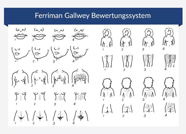 Grafik zeigt Ferriman Gallwey Bewertungssystem Grafik zeigt Ferriman Gallwey Bewertungssystem