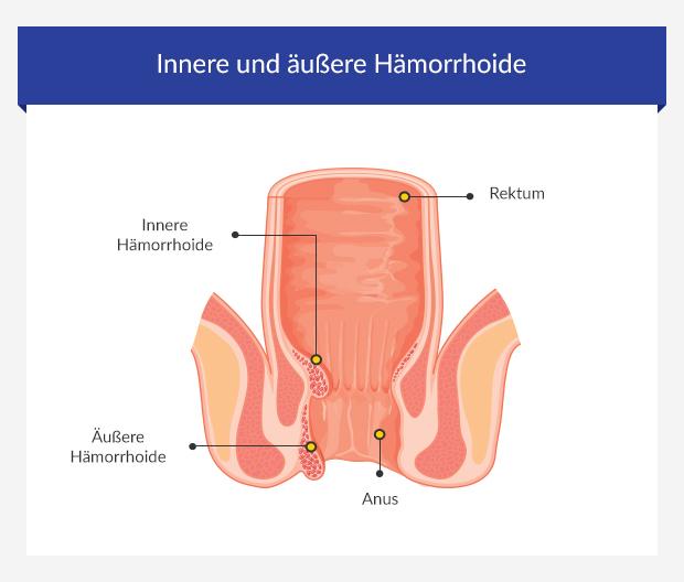Graphic illustrating internal and external haemorrhoids
