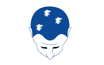 Alopecia areata