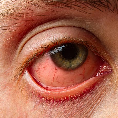 Kann ich Chlamydien im Auge bekommen?