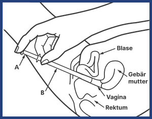 Infografik zeigt, wie der Canesten-Applikator eingeführt wird