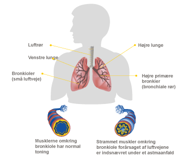 Sammensnøret luftveje under et astmaanfald