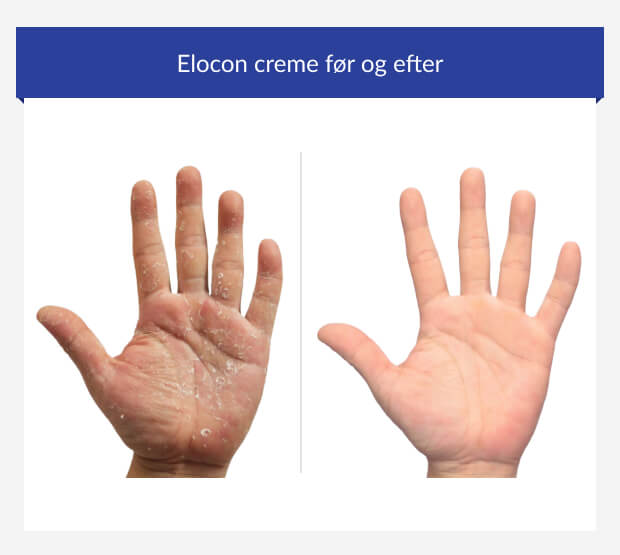 Palmoplantar psoriasis før og efter brug af Elocon creme