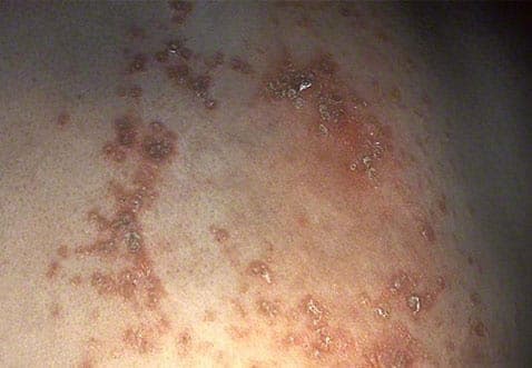 Herpes zoster virus som helvedesild