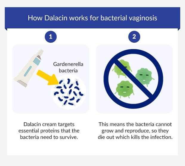 Graphic showing how Dalacin cream treats bacterial vaginosis infection