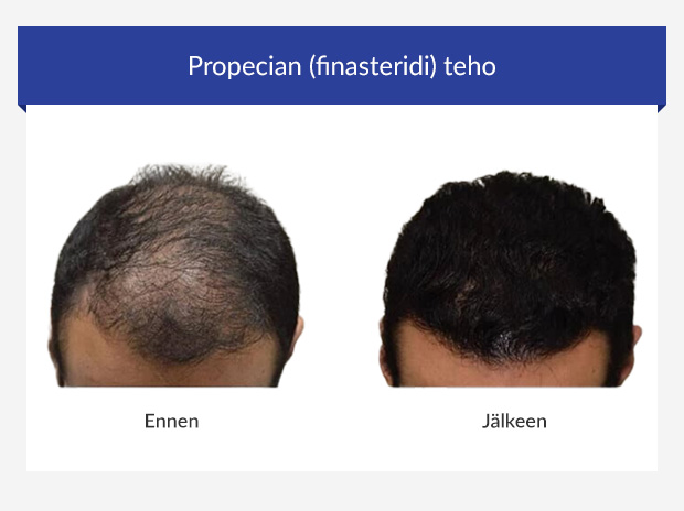 Ennen ja jälkeen kuva Propecian tehosta miehellä