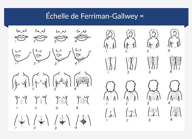 Graphique illustrant le score de Ferriman-Gallwey Graphique illustrant le score de Ferriman-Gallwey