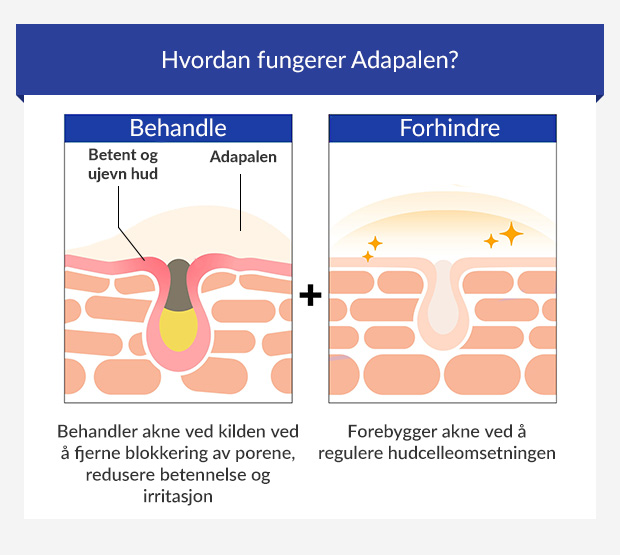 Infografikk som viser hvordan adapalen behandler og forebygger akne