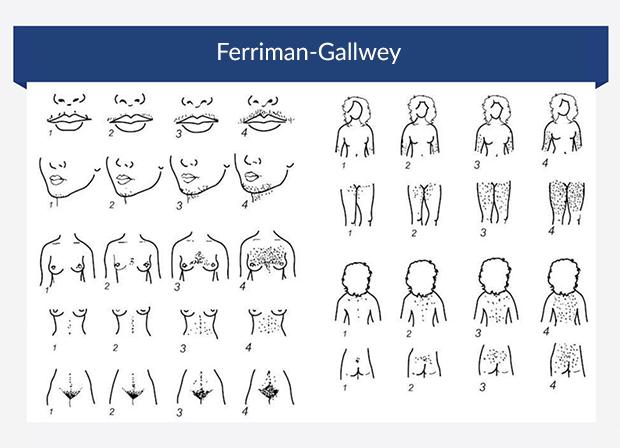 Alt: Gráfico ilustrando a partitura Ferriman-Gallwey