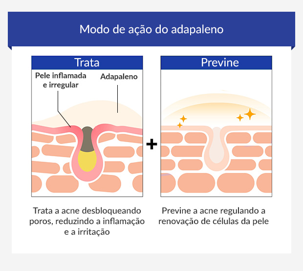 Infográfico a mostrar como o adapaleno trata e previne a acne