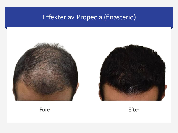 Före- och efterbilder av en man som använder Propecia