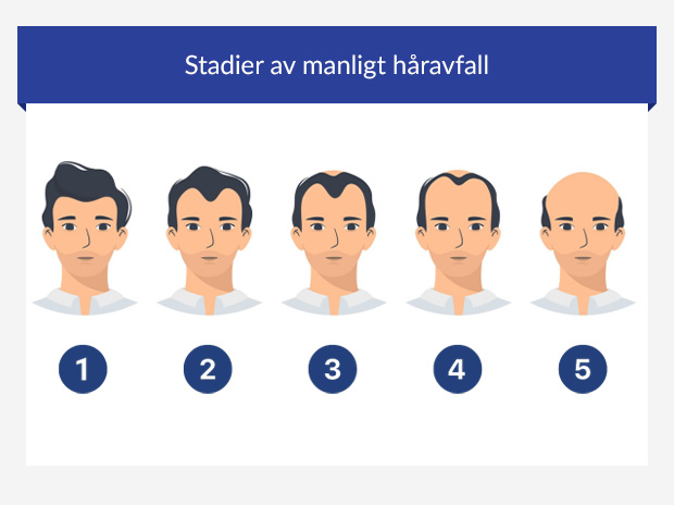 Grafik som visar stadierna av manligt håravfall