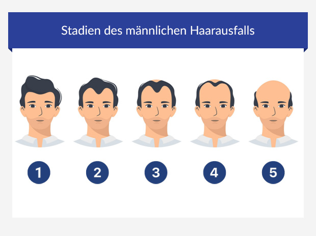 Grafik zeigt die 5 Stadien des Haarausfalls bei Männern 