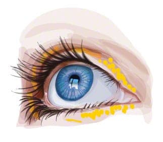 Ablagerungen bei hohem Cholesterinspiegel