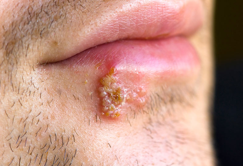 Fieberbläschen, das durch den Herpesvirus ausgelöst wird
