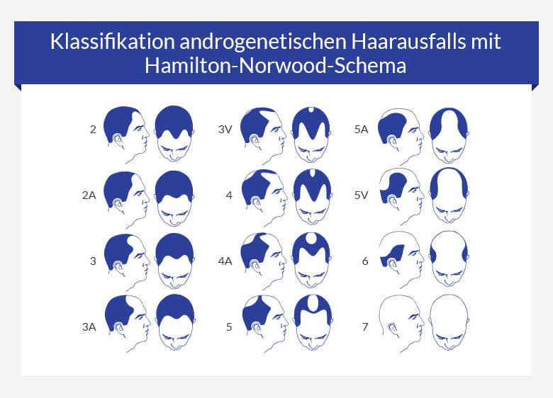 Haarausfall bei Männern nach Hamilton-Norwood