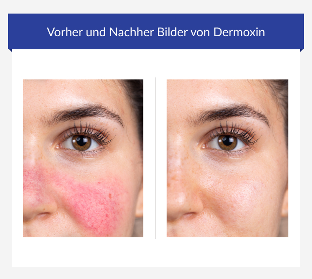 Vor und nach der Anwendung von Dermoxin