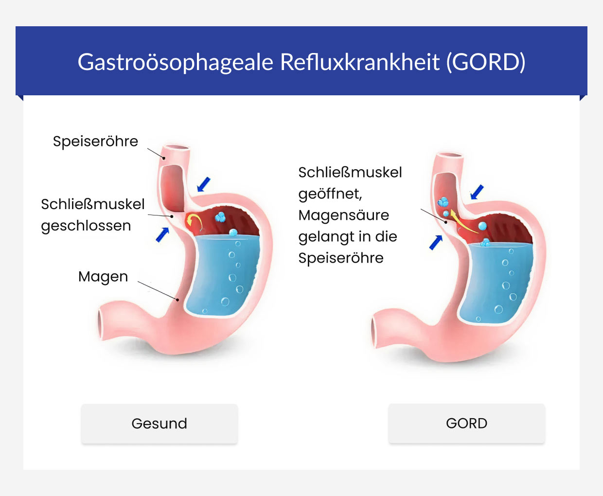 Gastroösophageale Refluxkrankheit (GORD)