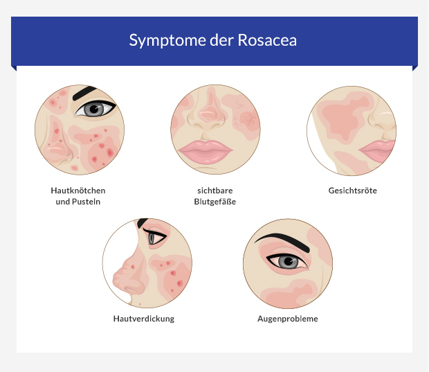  Symptome der Rosacea 