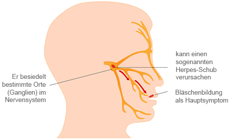 Verbreitung herpes Mumps