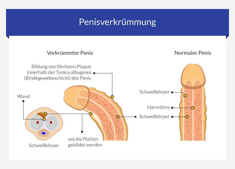 Penisdeviation Dr. med.