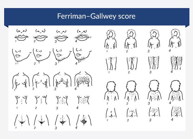 Grafik, der illustrerer Ferriman-Gallwey-score