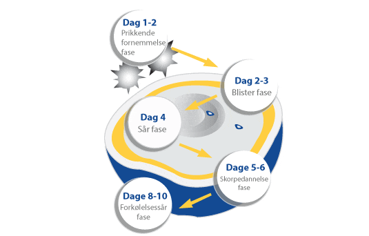 forløb og stadier ved forkølelsessår