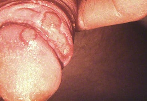 Helvedesild forårsaget af herpes zoster virus