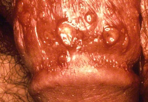 Herpes zoster virus som helvedesild