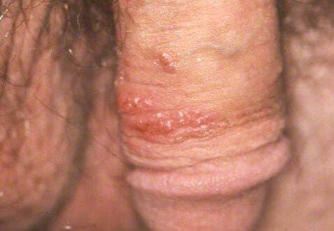 Kønsvorter på penis