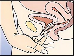 how-to-remove