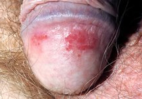 penis svampeinfektion
