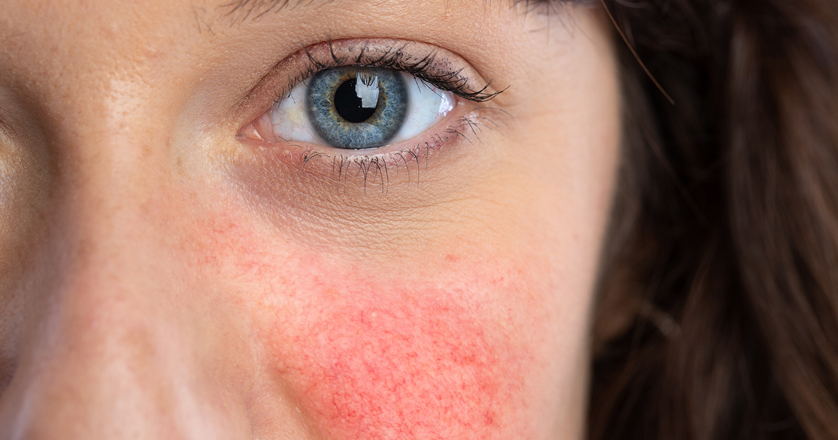 A close-up of a woman’s face with rosacea