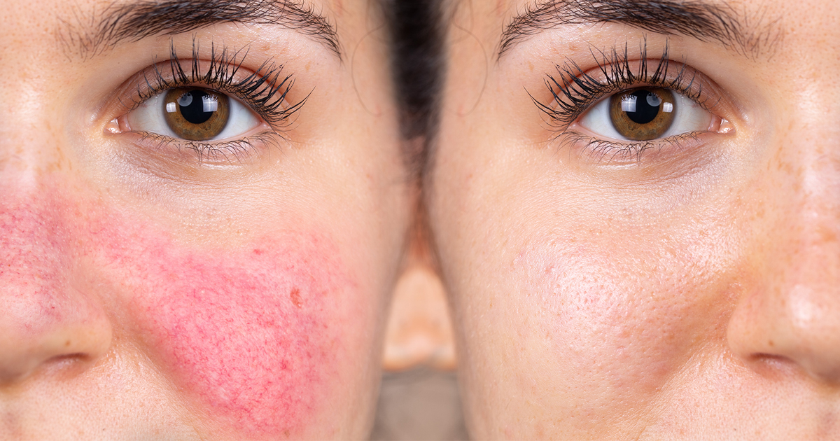 A close-up of the same woman with and without rosacea