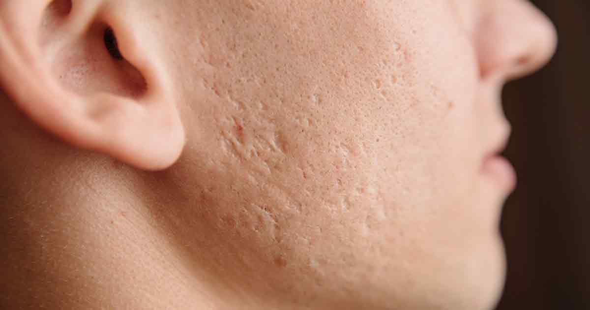 Close-up of a young man with acne scarring.