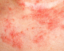 Close-up of eczema rash.