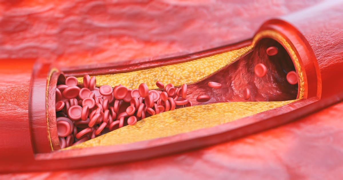 Closeup of atherosclerosis