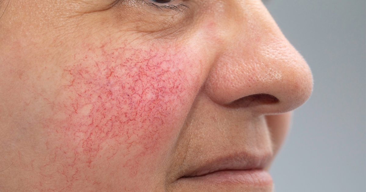 A close-up of a woman’s face with type 1 rosacea
