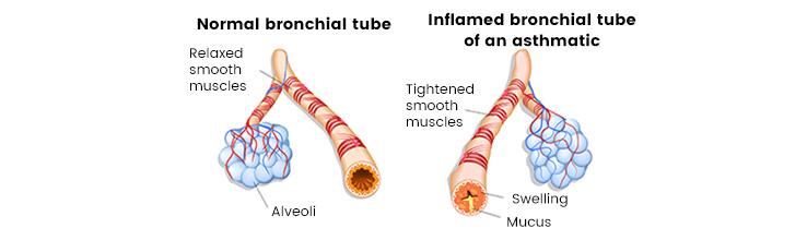 Diagram of asthmatic airways 