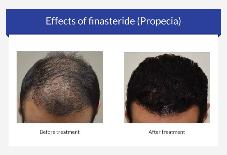 Buy Propecia Finasteride Tablets Online For Hair Loss Euroclinix