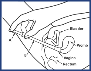 Infographic showing how to insert the Canesten applicator