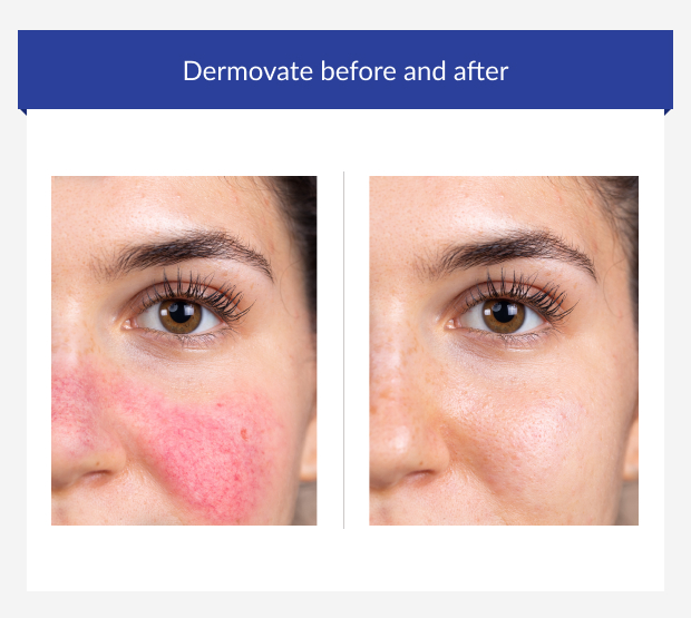 Before and after Dermovate use