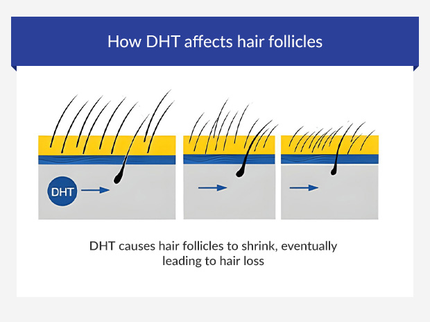 Graphic showing how DHT causes hair loss