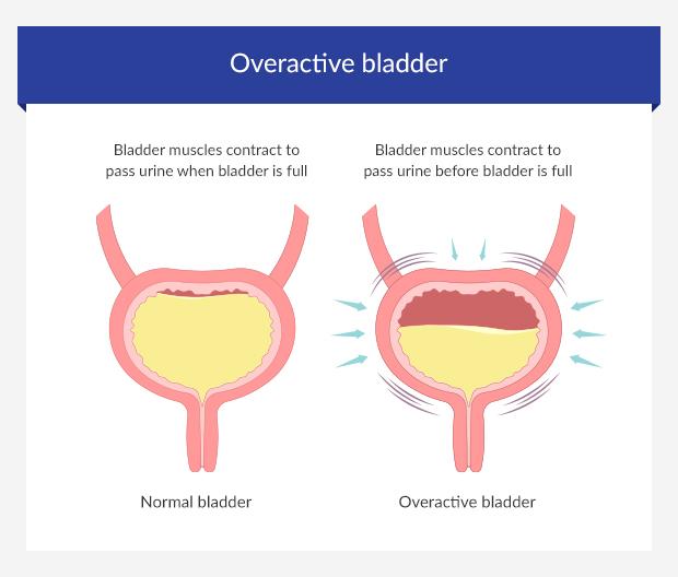 Urinary Incontinence Vs Urge Incontinence at Dianne Nichols blog