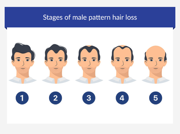 Graphic depicting the stages of male pattern hair loss
