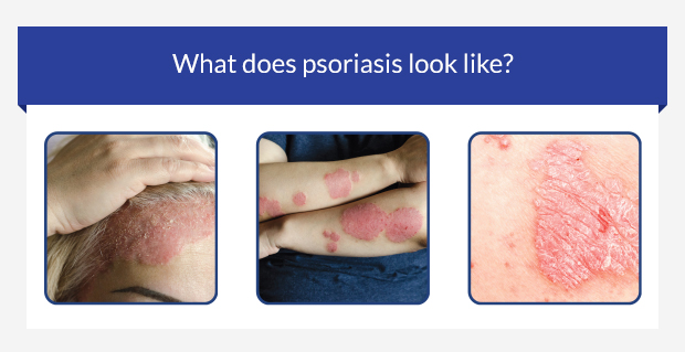 Psoriasis • Causes Symptoms And Treatments • Euroclinix®