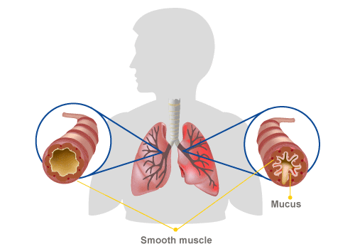 Exercise induced asthma