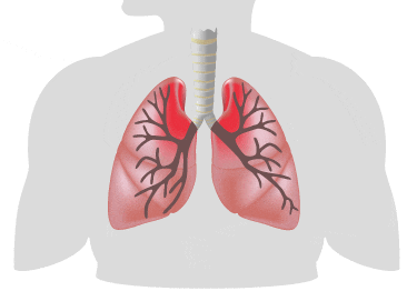 swollen and inflamed lungs during an asthma attack