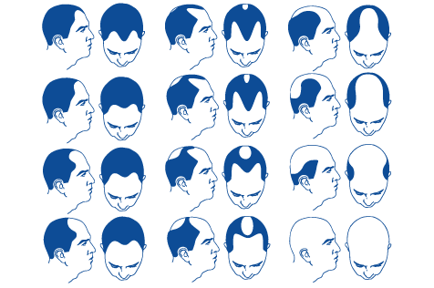 Hair Loss - Alopecia Causes, Symptoms & Treatment | euroClinix