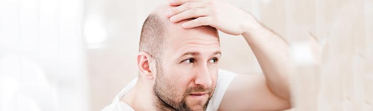 balding man showing hair loss